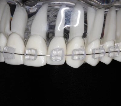 Foto de um modelo dental mostrando a utilização do aparelho estético
