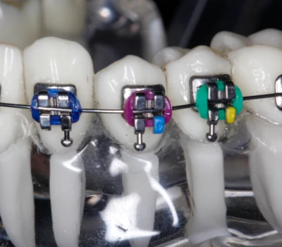 Mulher negra sorrindo mostrando os dentes com aparelho metálico